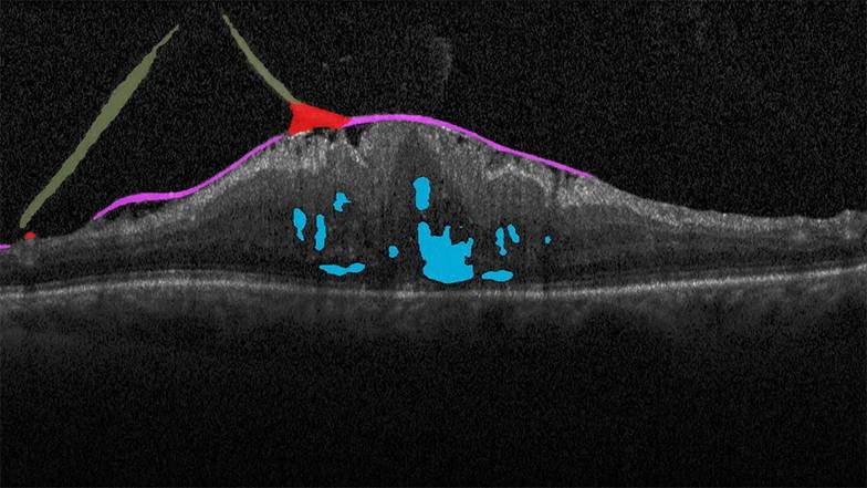  Скан ОКТ сетчатки позволяет видеть ее слои