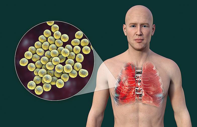 IMAGO/SCIENCE PHOTO LIBRARY По данным журнала The Lancet от 2022 года, бактрия золотистого стафилококка (Staphylococcus aureus) стала ведущим патогеном, ассоциированным со смертельным исходом, в 135 странах мира