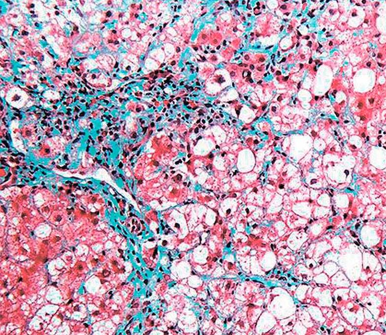  Сенесцентные клетки (окрашены) постарели, но по каким-то причинам не умерли