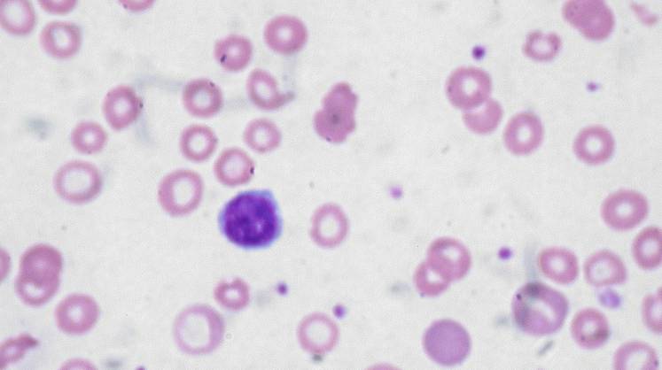Ученые обнаружили связь между гемоглобином и слабоумием